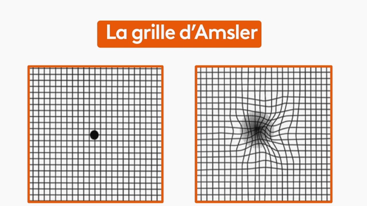 Santé - La DMLA