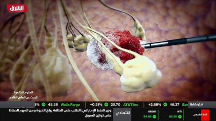 ...المرض ، ما ادى الى حدوث تطورات طبية في أ...