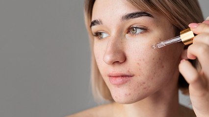 Bisa Lawan Jerawat, Ini 3 Manfaat Asam Glikolat untuk Kulit