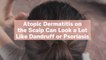 Atopic Dermatitis on the Scalp Can Look a Lot Like Dandruff or Psoriasis—Here's How to Tel