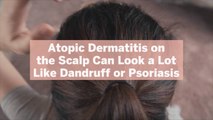 Atopic Dermatitis on the Scalp Can Look a Lot Like Dandruff or Psoriasis—Here's How to Tel