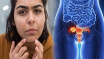 Women के Chin पर Unwanted Hair Ovary Tumor का Symptoms, कैसे पता करें | Boldsky