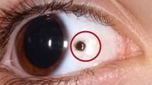 Eyes में Black Spots है खतरनाक बीमारी का संकेत । जानिए लक्षण और उपाय । Boldsky
