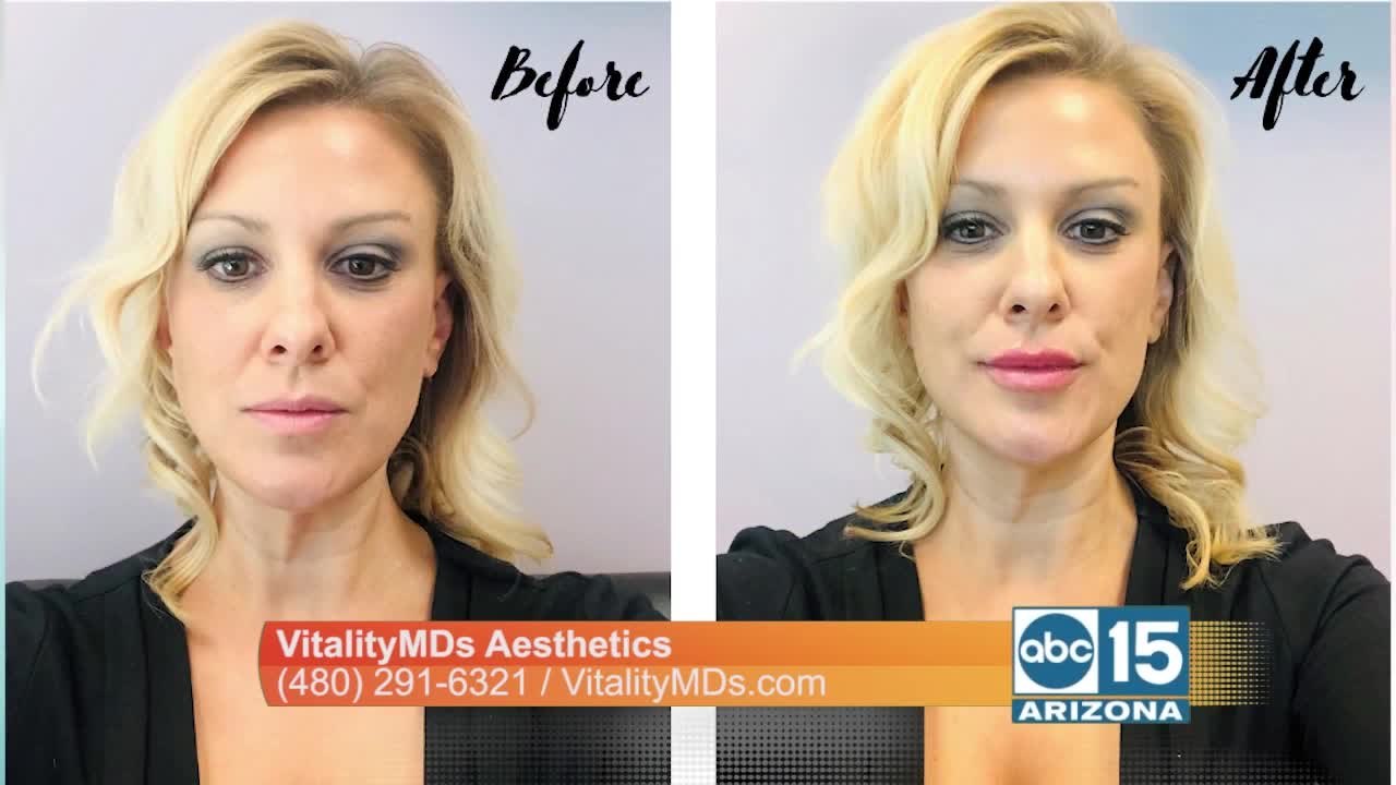 You can look amazing with injectable treatments offered at VitalityMDs Aesthetics