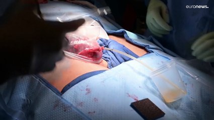 USA: 54 órán át működött a sertés vese emberi szervezetben