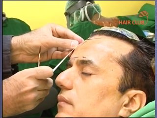 Dr.Ali Kazmi Hair Transplant in Lahore - Before After Results
