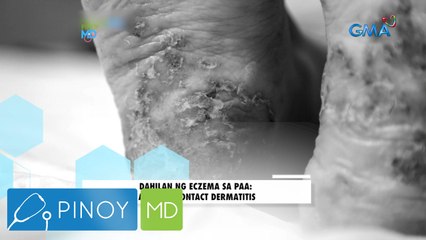 Pinoy MD: The most ommon cause of eczema