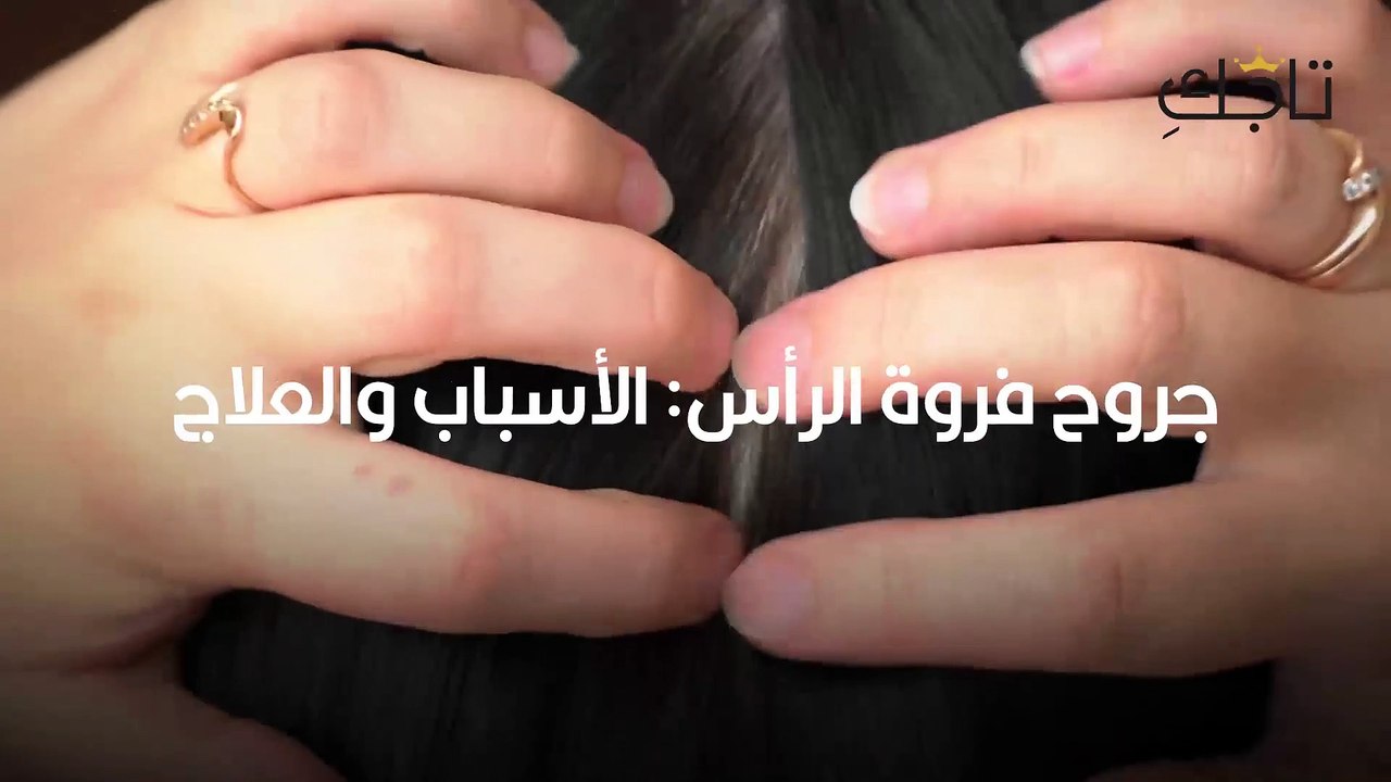 جروح فروة الرأس