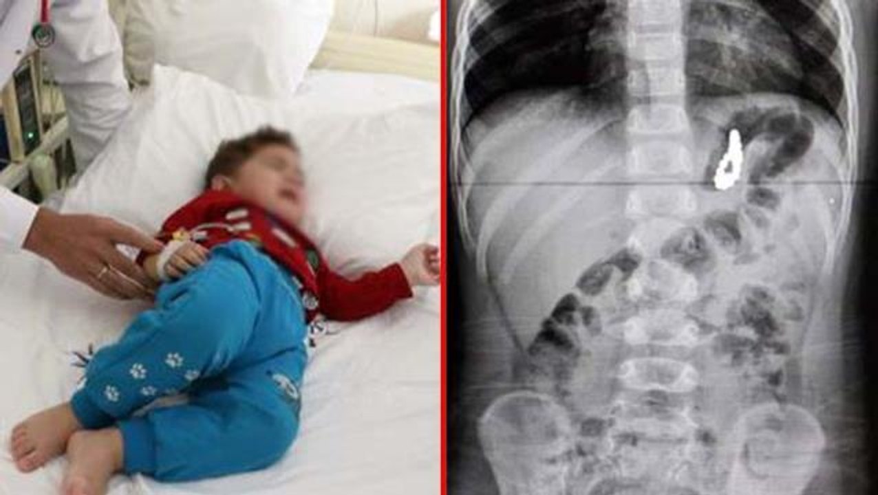 19 aylık Murat'ın midesinden 17 boncuk mıknatıs çıkarıldı