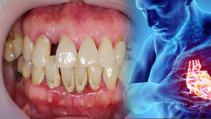 मसूड़ों की सूजन Heart Attack का Symptom, Periodontal Disease को नजरअंदाज करना जानलेवा | Boldsky