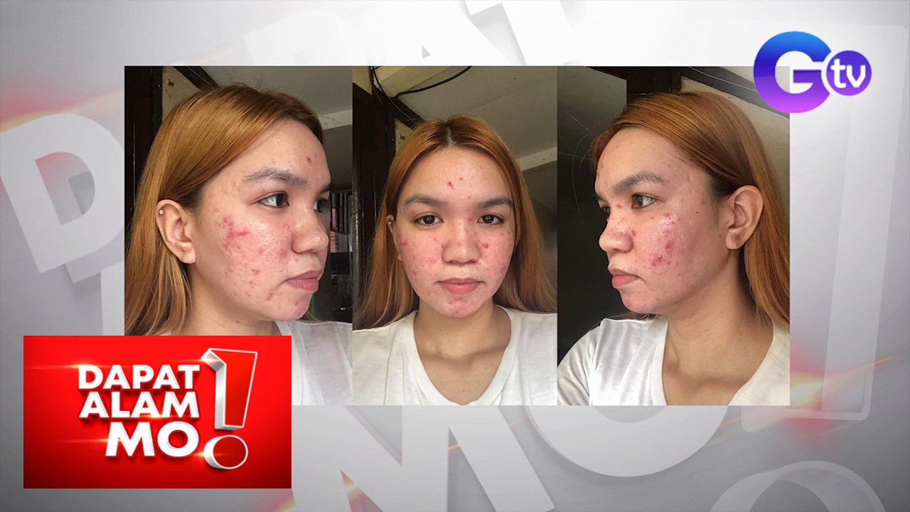 Dapat Alam Mo!: May skin peeling effect ba ang skin care routine mo?