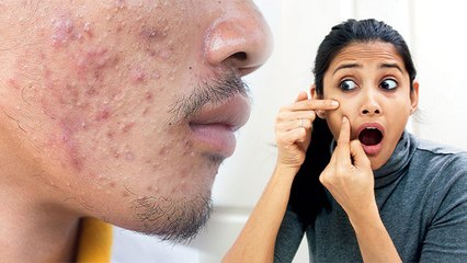 Face पर इस तरह मुंहासे हो सकते है खतरनाक,जानिए इसके पहचानने के तरीके और इलाज । Boldsky