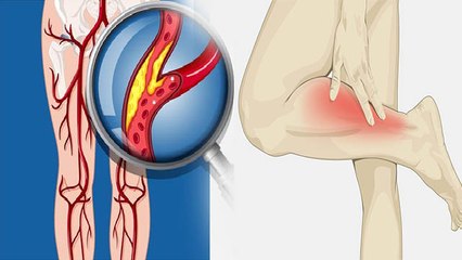 लगातार पैरों में दर्द Hyperlipidemia के Symptoms, Body पर जानलेवा Effect | Boldsky