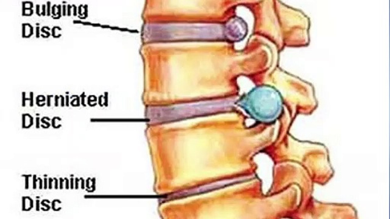 Daily Exercise for Back Pain | Sciatica Pain Relief Exercises | Sciatica | Slip-Disc