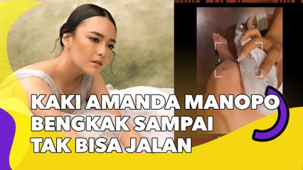 Kaki Amanda Manopo Bengkak Sampai Tak Bisa Jalan, Kondisinya Bikin Cemas