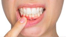 दांत हिलना कैसे बंद करें | Dant Hilane Ka Ilaj | Boldsky