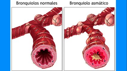 bd-abordaje-adecuado-del-asma-y-opciones-de-tratamientos-281021