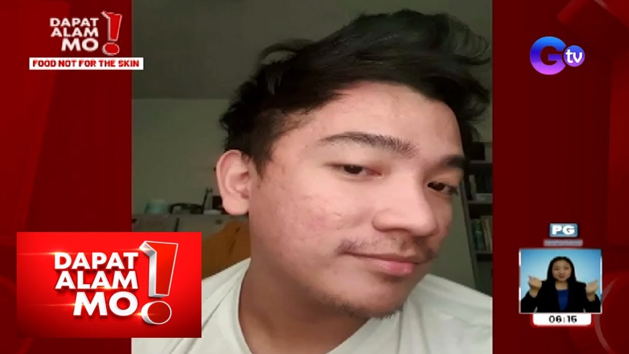 Dapat Alam Mo!: Ano ang totoong epektibong home remedies sa pimples at iba pang skin problems?