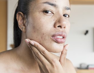 Here's All You Need to Know About Salicylic Acid