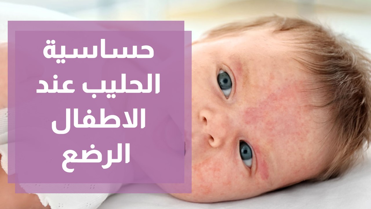حساسية الحليب عند الاطفال الرضع