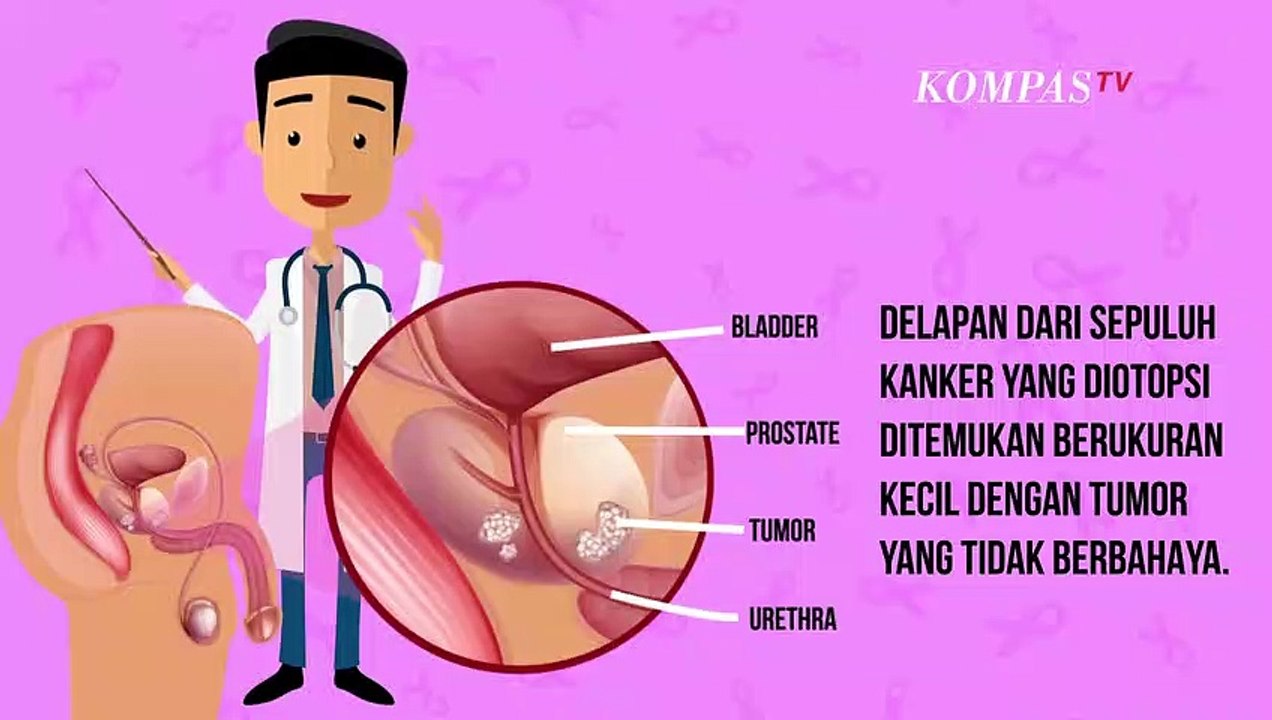Penting, Berikut Faktor Risiko dan Penyebab Kanker Prostat