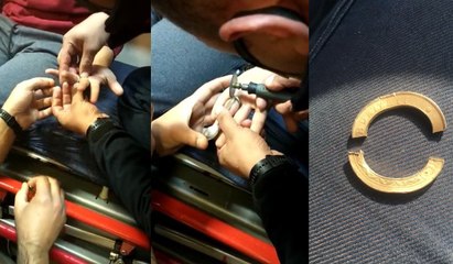 Madeni paradan yaptığı yüzük hastanelik etti