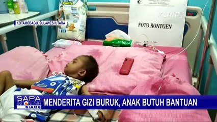 Terbaring Lemah, Anak 7 Tahun Alami Gizi Buruk Butuh Bantuan