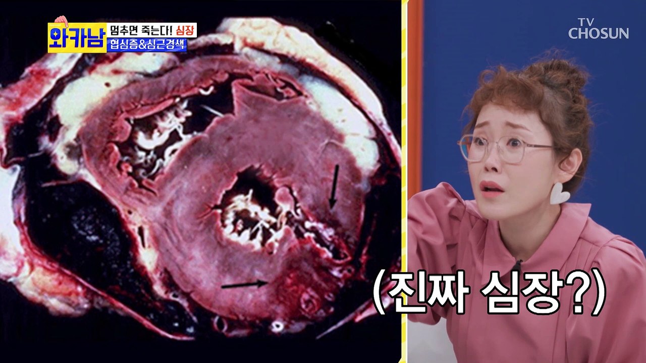 심장 질환 중 돌연사 원인 1위.. ‘협심증&심근경색’ 대표증상은? TV CHOSUN...