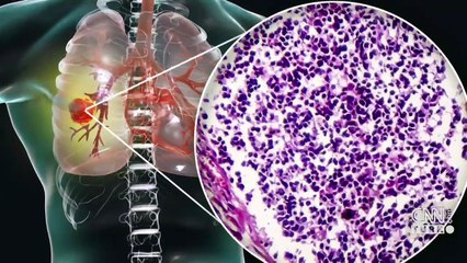 Akciğer kanseri mi, koronavirüs mü?