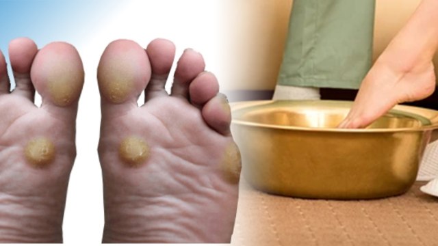 पैर के तलवे में गांठ का जबरदस्त इलाज | Pair Ke Talwe Me Ganth Ka Ilaj | Boldsky