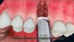 Dental Implants by MIS Matrix Surgery Guid