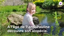 Alopécie : Pauline est devenue chauve à 13 ans