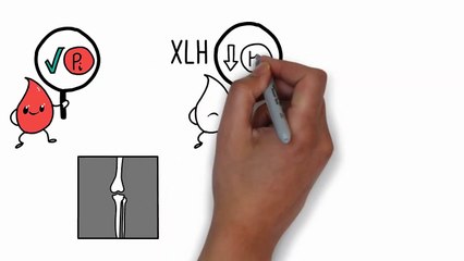 What Is XLH? Understanding Hypophosphataemia 🦷