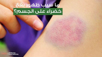 ما سبب ظهور بقع خضراء على الجسم؟