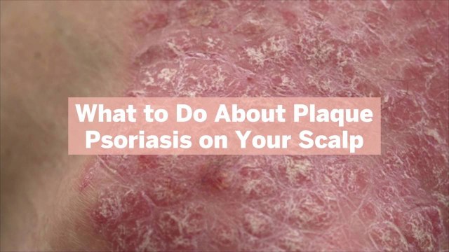 What to Do About Plaque Psoriasis on Your Scalp: Dermatologist-Recommended Treatments
