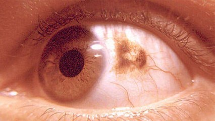 आंखों में काले धब्बों का होना है बेहद गंभीर समस्या,जानिए लक्षण और उपाय । Boldsky