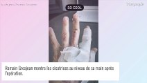 Romain Grosjean dévoile son impressionnante cicatrice à la main après l'opération