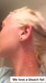 Woman Accidentally Burns Her Skin While Bleaching Her Hair
