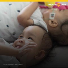 Después de la separación, siamesas de Bután quieren estar cerca