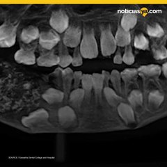 Médicos encuentran más de 500 dientes extras en la boca de un niño