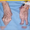 Llega a los 94 aos con impresionante malformacin en manos y pies