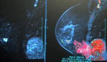 Color de Vida: Mamografías gratuitas durante el mes de octubre