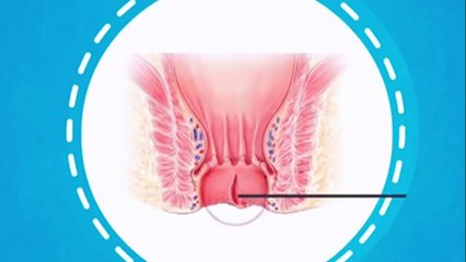 bd-hablamos-sobre-diagnostico-y-tratamiento-de-hemorroides-161121