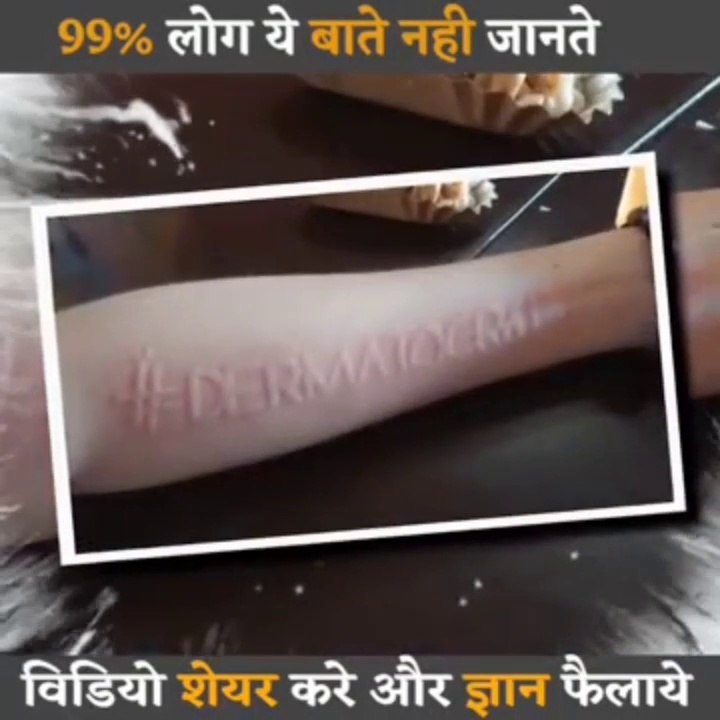 यह बीमारी लोगो पर छोड़ती हैँ ख़तरनाक निसान This disease is dangerous for people  #amazing #facts on dailymotion #omg