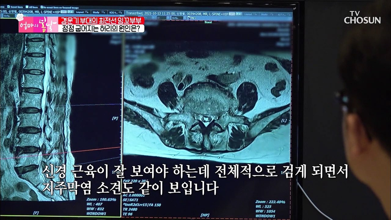 수술도 어렵다는 엄마의 허리 놀라운 시술 결과! TV CHOSUN 20211114 방송