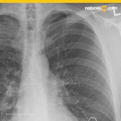 Termina con una costilla rota por brutal ataque de tos