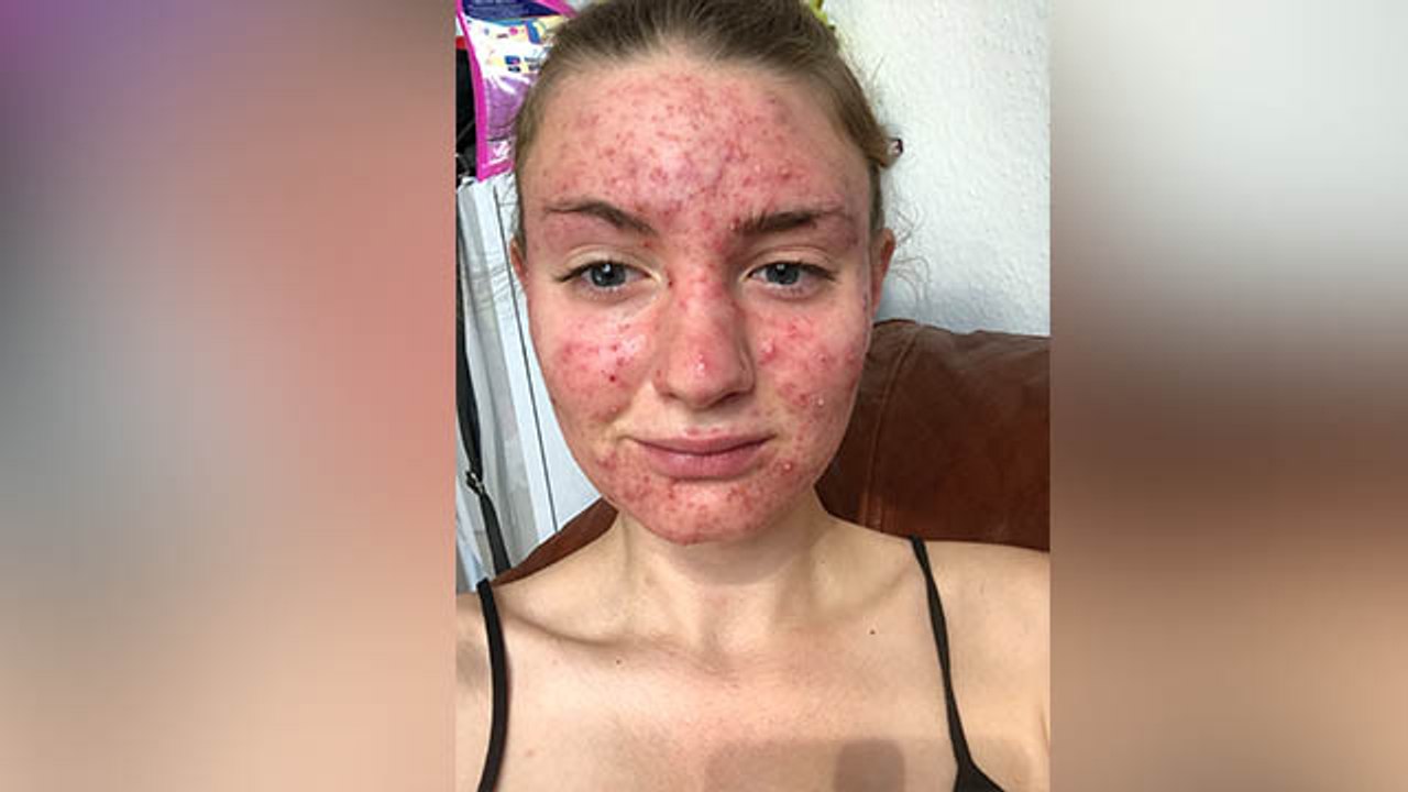 Cystic Acne क्या होता है, क्या होते हैं इसके कारण | What is Cystic Acne and Reasons | Boldsky