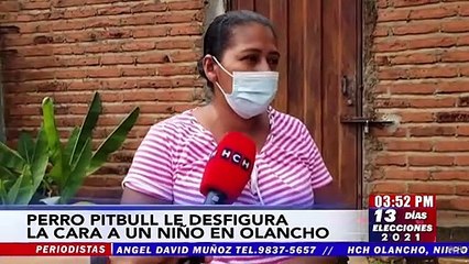 ¡Horrible! Pitbull le desfiguró rostro a niño de 2 años en Olancho