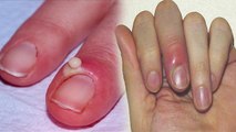 Paronychia क्या है, Finger के कोने में दर्द की ये बीमारी खतरनाक है कि नहीं | Boldsky