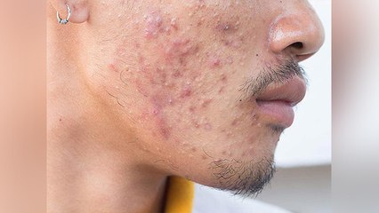 चेहरे पर गड्ढे क्यों होते है। चेहरे पर गड्ढे हटाने का सबसे आसान तरीका । Boldsky